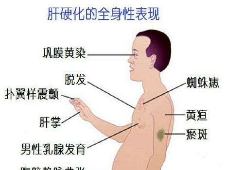 适合肝硬化病人的食谱