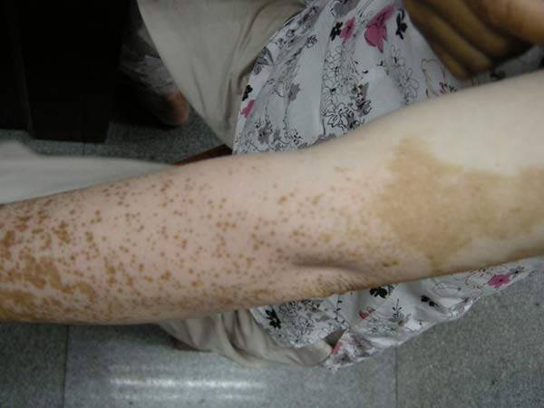 白殿疯患者食谱