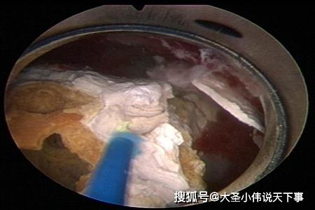 碎石后食谱