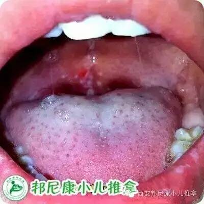 儿童疱疹食谱