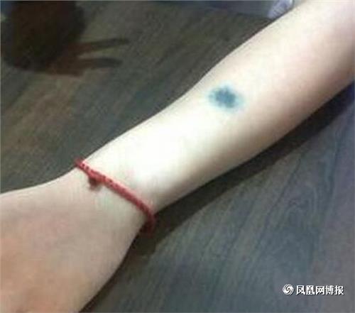 肩膀有胎记的人命运