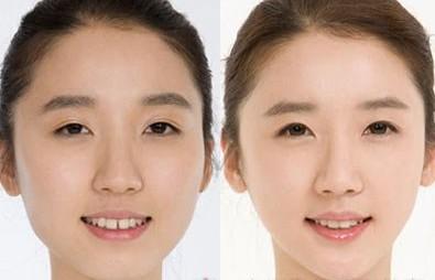 门牙一半缝的女人命运