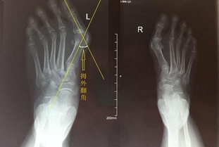 小趾外翻男人命运苦
