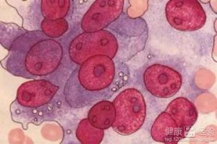 淋巴瘤化疗食谱